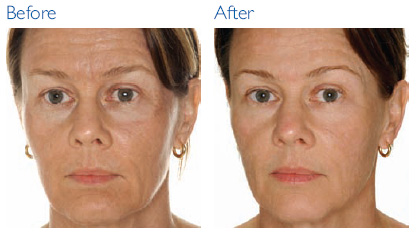 mesotherapy face facial perfect neck procedure informed cannot fully